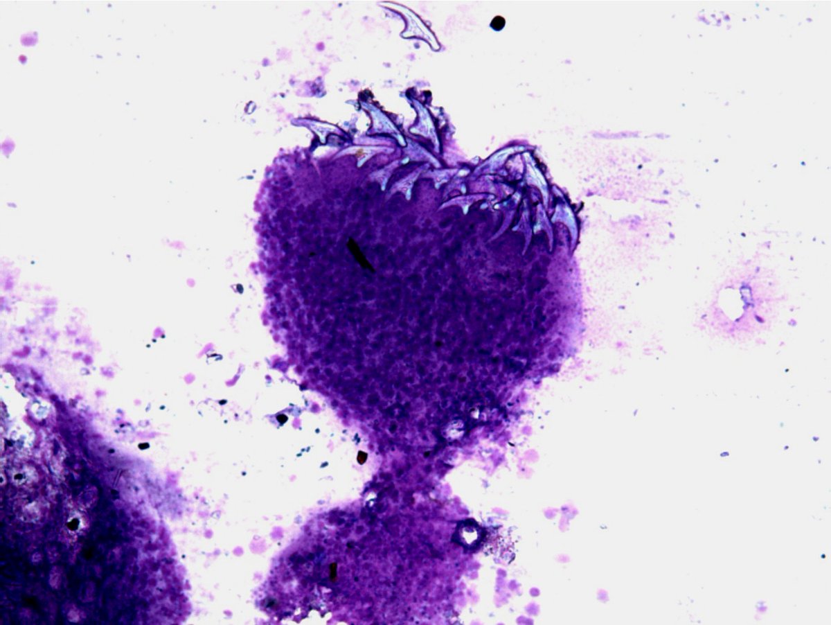 njayaram1959's tweet photo. Perseverance pays... Lessons learnt in the bud. 
Years ago I aspirated purulent material from a suspected sarcoma in the calf region. Initially saw few acellular flakes in addition to inflammatory cells. I sieved the entire pus to pick up particles. Lo and Behold https://t.co/FPvxPYllkB