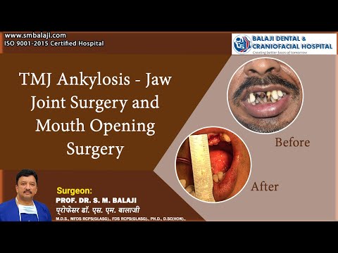 balajidental's tweet photo. TMJ Ankylosis - Jaw Joint Surgery and Mouth Opening Surgery
#TMJAnkylosis #TMJSurgery #TMJoint #smbalaji #maxillofacialsurgery
https://t.co/xSDw7LeUHz https://t.co/5blw7DfXRd