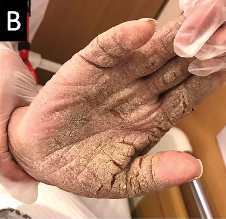 BrownJHM's tweet photo. A 78-year-old man with dementia &amp; DM presented with a rash and intense itching over the entire body from the feet to the scalp. Exam noted widespread crusted hyperkeratotic lesions on the trunk, arms &amp; hands. What is the diagnosis &amp; treatment? #Medtwitter https://t.co/vzKwnNxi5O https://t.co/MNN7bICux0