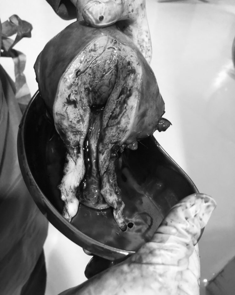 I miss the OR but I never want to assist anymore surgery where the patient is my loved one. 

This is my sister's uterus.