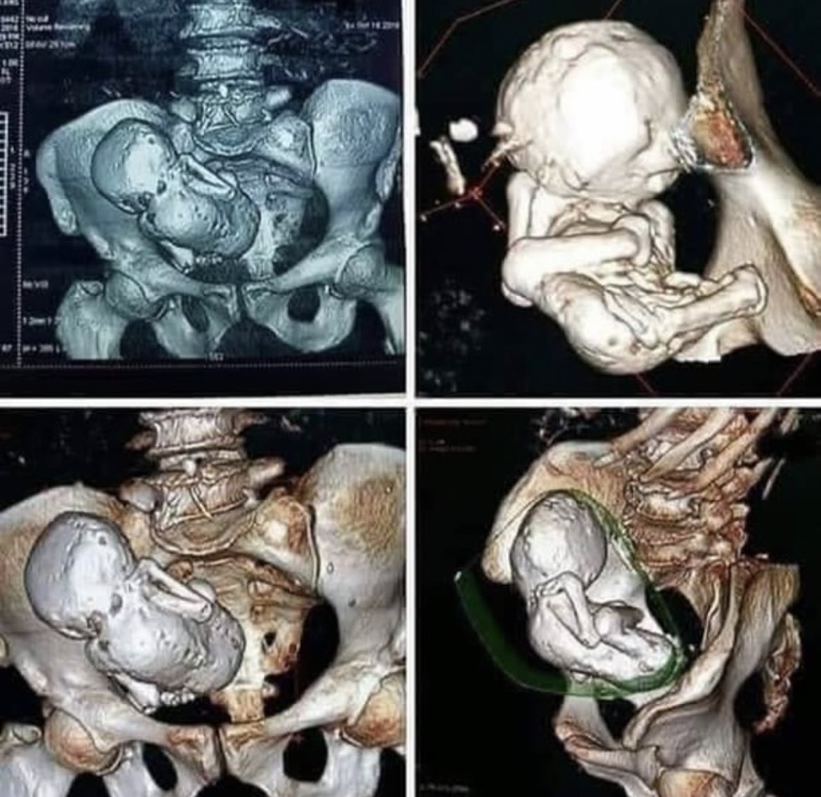 Lithopedion ( Bebé de piedra) es un término para describir un feto calcificado. Hay 300 casos descritos, afortunadamente es una situación extremadamente rara.