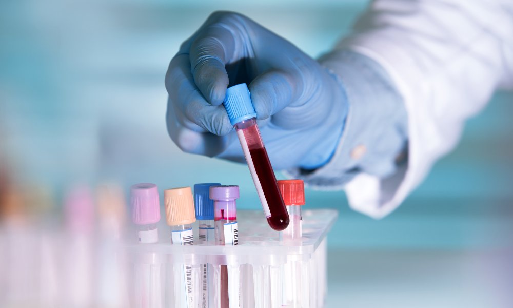 Fibrosis improvement may not continue more than a year after hepatitis C cure in people with HIV infohep.org/page/3550923/