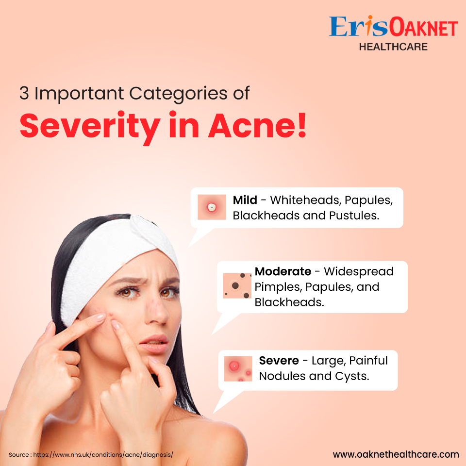 OaknetHealth's tweet photo. 3 Important Categories of Severity in Acne!
There are 3 categories of acne, divided as per the severity.
A. Mild - Whiteheads, Papules, Blackheads, and Pustules.
B. Moderate - Widespread Pimples, Papules, and Blackheads.
C. Severe - Large, Painful Nodules and Cysts.

#Acne #PCOD https://t.co/VGipC2djl6