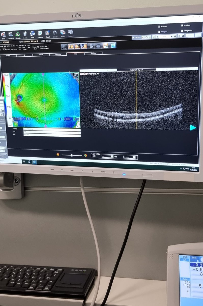 RichardIlderton's tweet image. Appears I have healthy eyeballs 😁

#EyeTest #Optician #EyeScan #Science