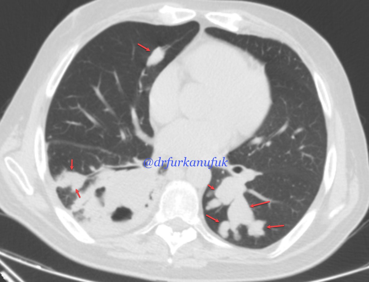 drfurkanufuk's tweet photo. Endobronchial metastasis from clear cell carcinoma of the kidney. Axial CT scan shows endobronchial branching nodules (arrows). #radiology #FOAMRad   @TLHM_MD @AwsHamid5 @AvrahamCooperMD @JeffreyKanneMD @CardiacBronchus @hochhegger @ShravSridhar @farouk_dako @marcosmestas https://t.co/ZpVgiX33PV