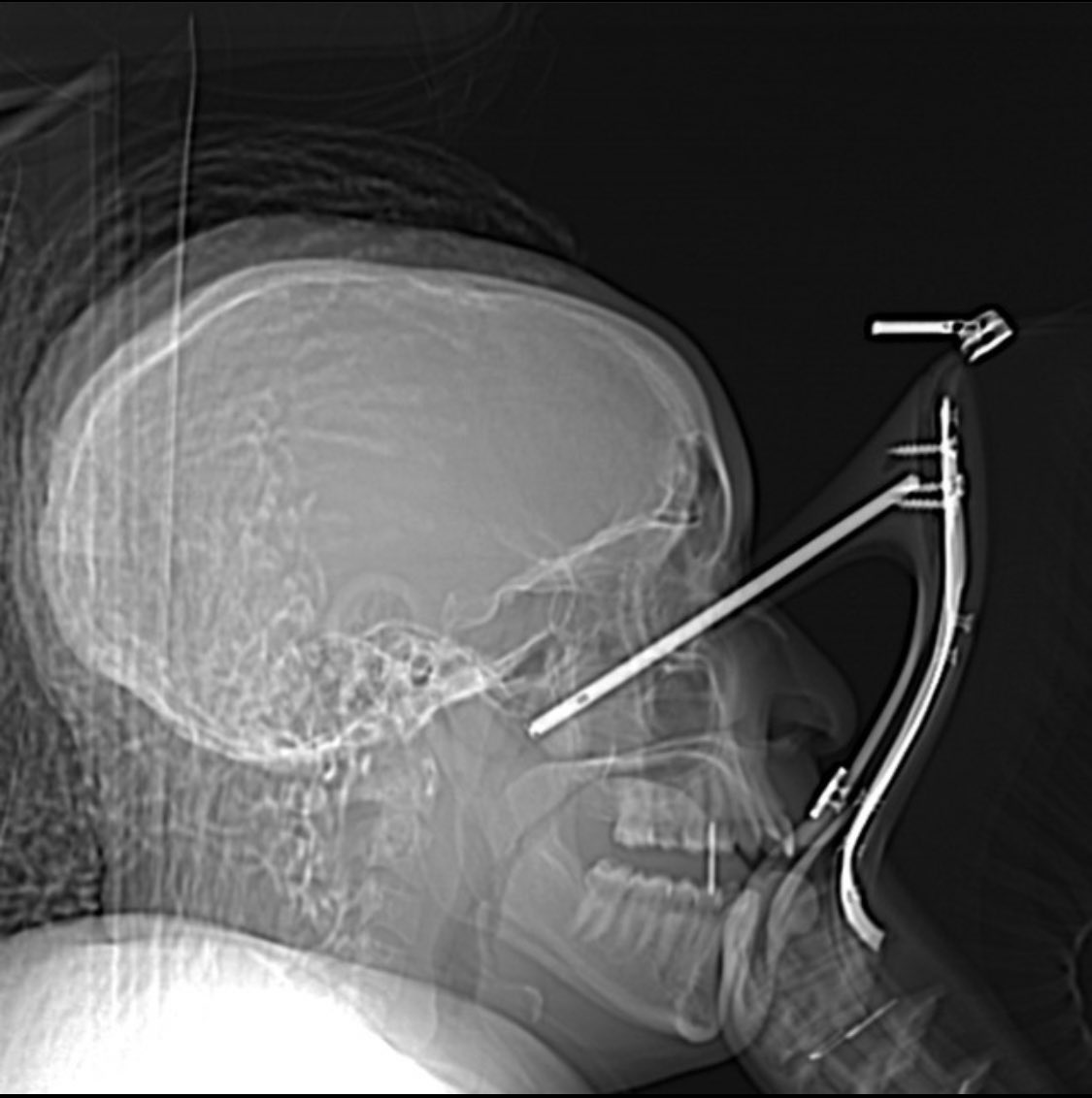 XrayProblems's tweet photo. I just need to know the story behind this one 👠
#xrayprobs #radtech #radiology #ctscan https://t.co/70plndaJQv