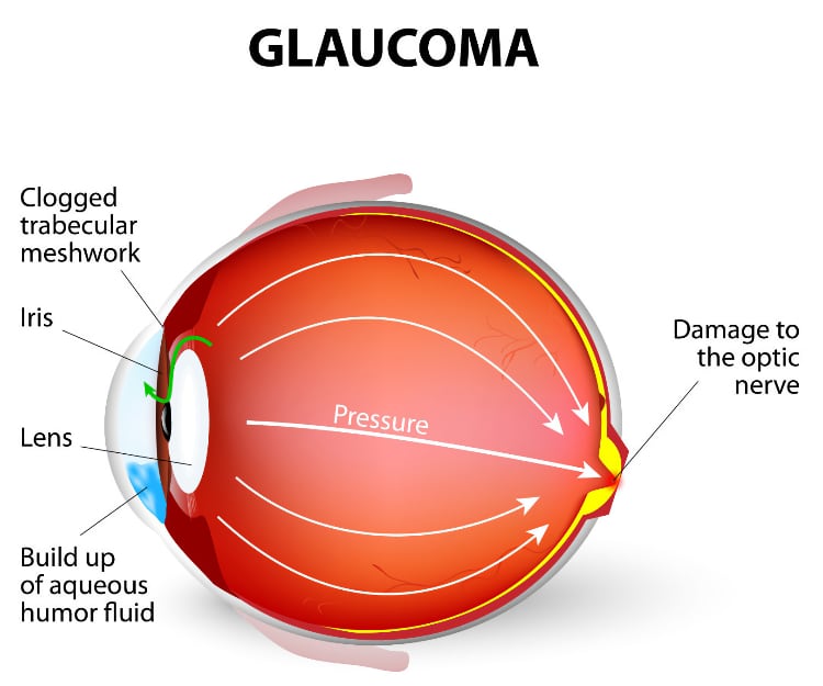 Eastbourne Eye Surgeon (@eyesurgery1) on Twitter photo Find out more about Glaucoma and who is at risk of getting glaucoma in our blog here: #Glaucoma #eyehealth #Eastbourne ow.ly/5gAE30sr1Lo Find out more about Glaucoma and who is at risk of getting glaucoma in our blog here: #Glaucoma #eyehealth #Eastbourne ow.ly/5gAE30sr1Lo