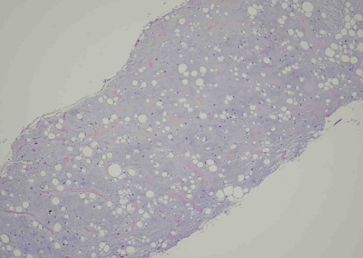 Thigh mass biopsy from young adult. Differential? Next steps? Grade?
#BSTpath