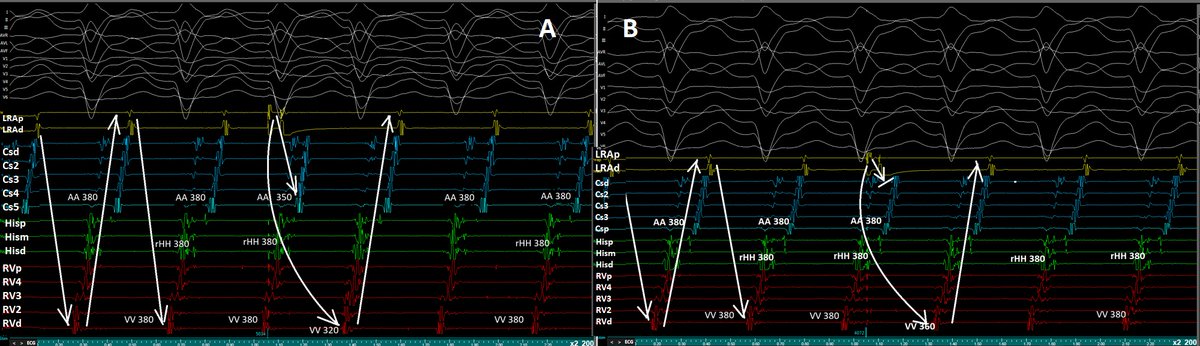 Importance of the ‘’Septal refractory’’ versus ‘’his refractory’’ APC in DD of WCT @AhmetKorkmaz07A @Mkara_EP @ElifhandeMD @SerhatKocadr @mrselah78959414 @emin_karimli @ozcanozeke @prof_serkan_cay @drfiratozcan @DursunAras2 @topaloglu_prof @GeorgeKleinMD doi.org/10.1002/joa3.1…