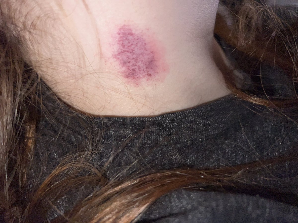 RhodyFemboy's tweet photo. Anyone else just… HATE hashtags? Community engagement etc, etc, but they’re just unnatural to me 

Anyway here’s a mark I left on a slutty little bimbo last night https://t.co/4TO1391pS1