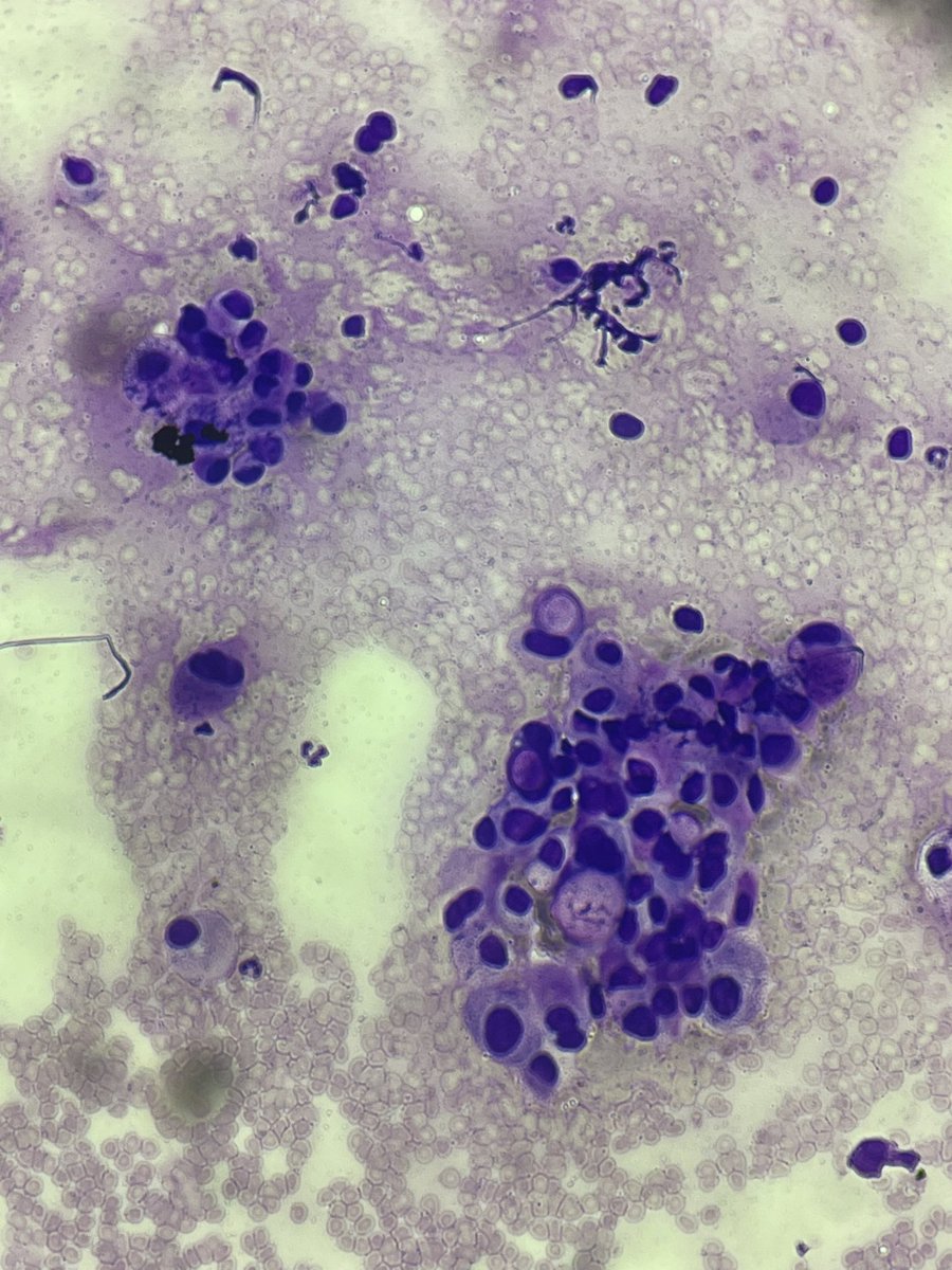 fleiva_cepas's tweet photo. Signet cell tumor. Stomach. #cytopath #PathTwitter ##residentpath @aphurs https://t.co/BsNv3rLJnx