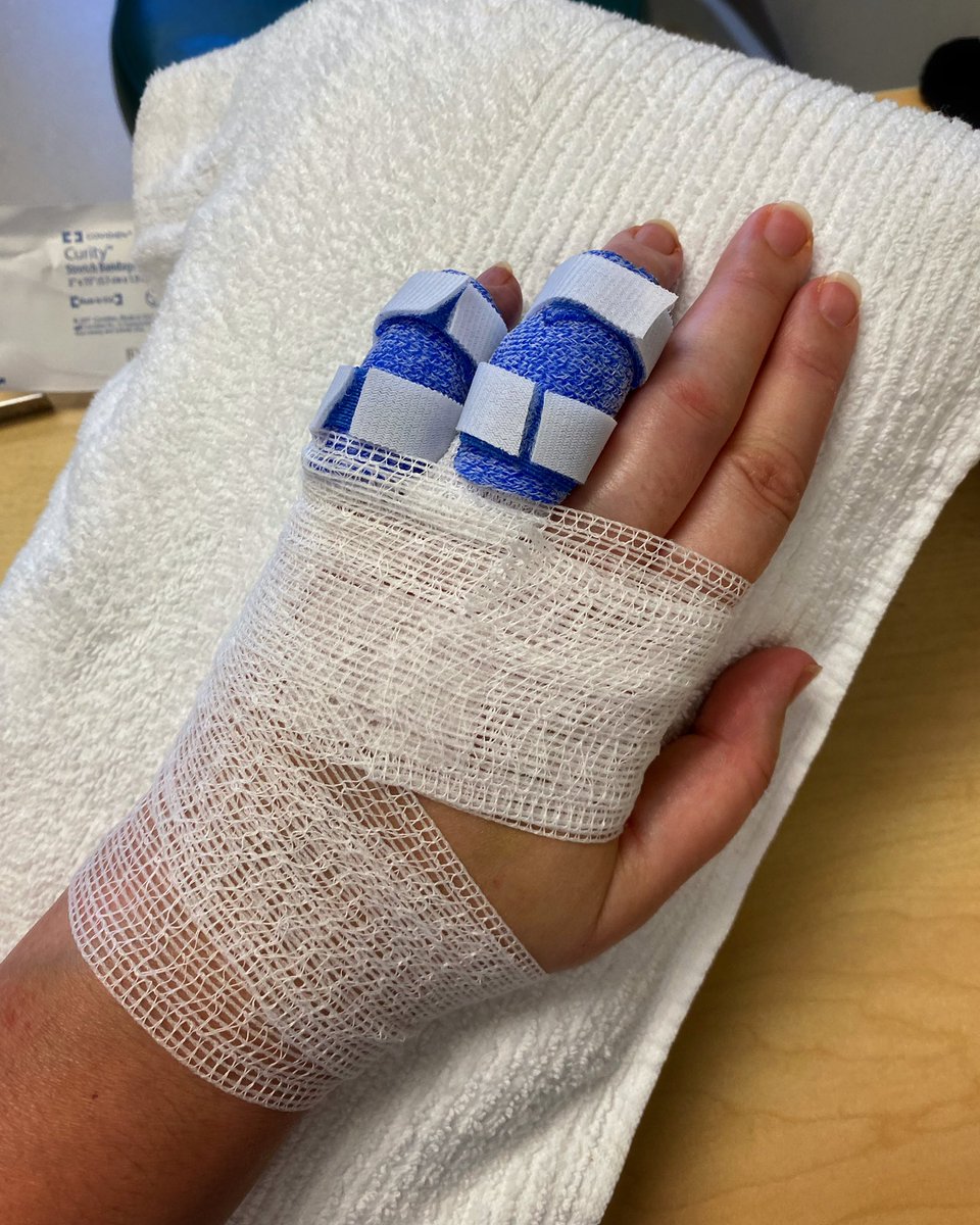 geekamy's tweet photo. I had surgery on two fingers and now they are each in their own little cast. #dupuytrens https://t.co/GSdXMVKxEW