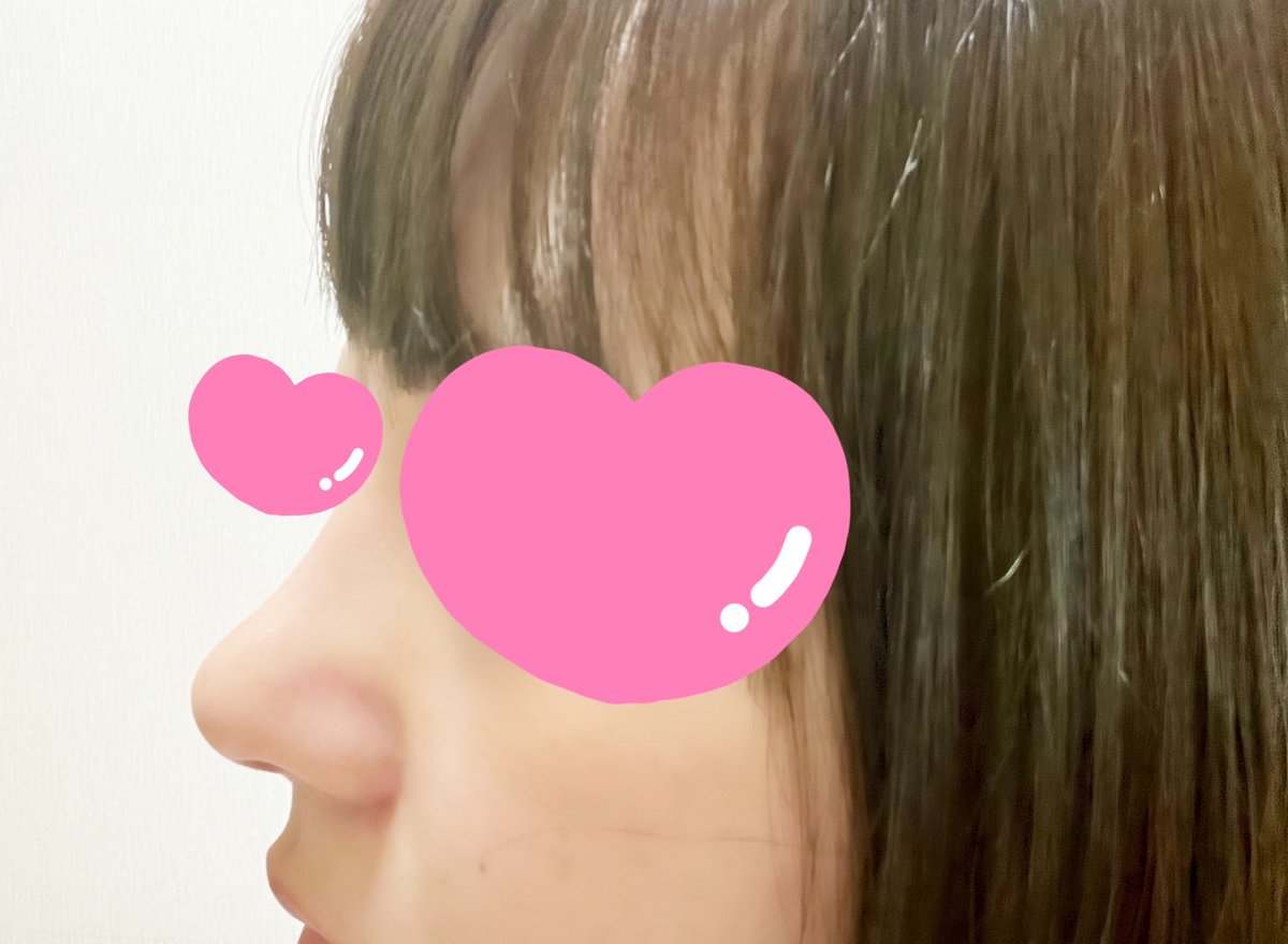 a0x_j's tweet photo. @gamipsjapan  
ガミ整形外科　鼻フル　1ヶ月レポ
腫れてるような感じは感じなくなり、赤みや痛みも気にならなくなりました。
鼻先の異物感とたまに傷跡が痛むような気がしますがそこまで問題ないです。
鼻の高さも違和感なく馴染んできた気がします。 https://t.co/WEZgaOD8Gx