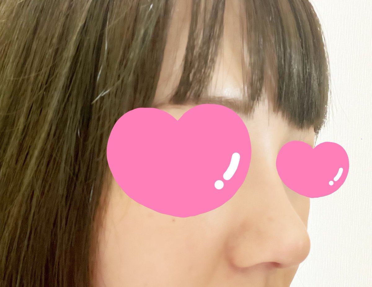 a0x_j's tweet photo. @gamipsjapan  
ガミ整形外科　鼻フル　1ヶ月レポ
腫れてるような感じは感じなくなり、赤みや痛みも気にならなくなりました。
鼻先の異物感とたまに傷跡が痛むような気がしますがそこまで問題ないです。
鼻の高さも違和感なく馴染んできた気がします。 https://t.co/WEZgaOD8Gx