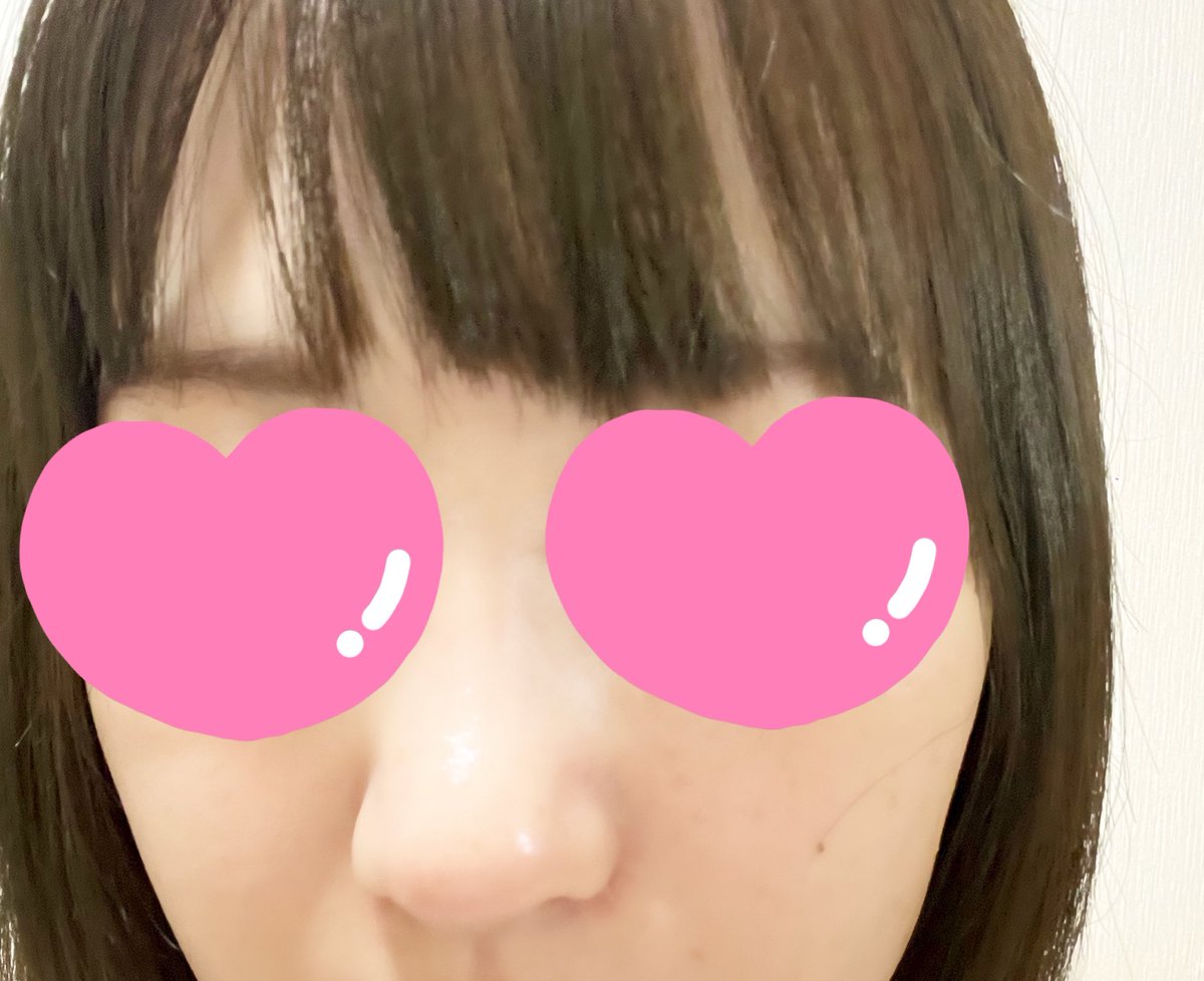 a0x_j's tweet photo. @gamipsjapan  
ガミ整形外科　鼻フル　1ヶ月レポ
腫れてるような感じは感じなくなり、赤みや痛みも気にならなくなりました。
鼻先の異物感とたまに傷跡が痛むような気がしますがそこまで問題ないです。
鼻の高さも違和感なく馴染んできた気がします。 https://t.co/WEZgaOD8Gx