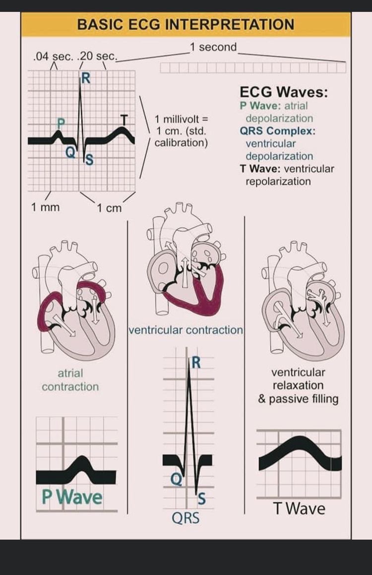 MattersoftheH14's tweet photo. #ECGWaves https://t.co/yaijtXjYE2