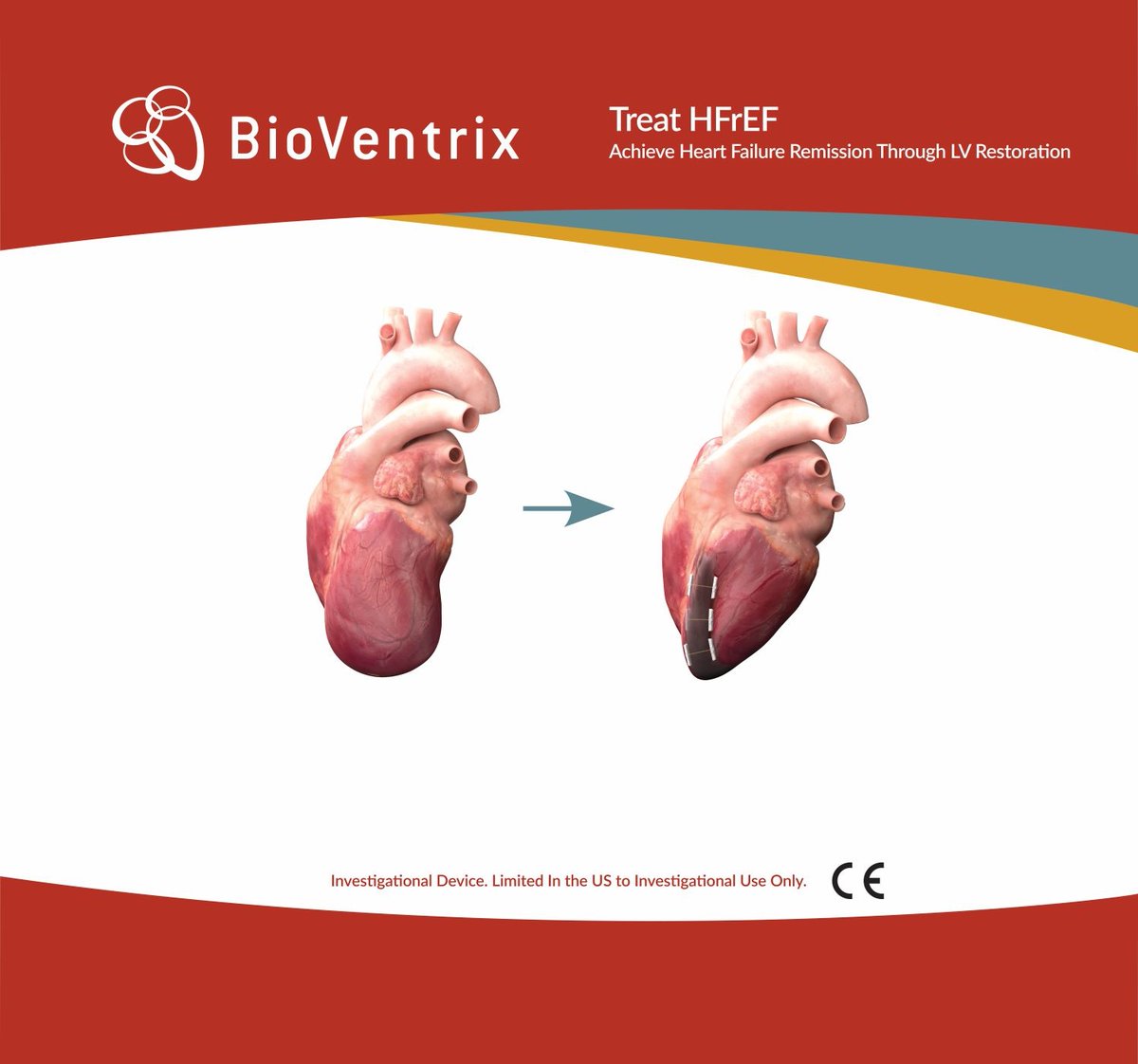 BioVentrix (@bioventrix) on Twitter photo Stop by our booth #224 at #HFSA2022 to learn more about treating HFrEF to achieve Heart Failure Remission through LV Restoration with BioVentrix.
 
#HeartFailure #StructuralHeart #LVreshape #ReviventTC #LIVETherapy
@hfsa Stop by our booth #224 at #HFSA2022 to learn more about treating HFrEF to achieve Heart Failure Remission through LV Restoration with BioVentrix.
 
#HeartFailure #StructuralHeart #LVreshape #ReviventTC #LIVETherapy
@hfsa