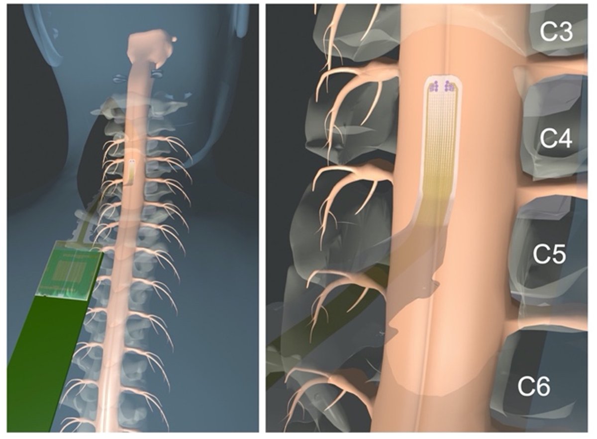 ScienceTM's tweet photo. Scientists have created a #microelectrode array that provides high-definition, 2D maps of spinal cord activity during #SpinalSurgery in patients—which outperformed current intraoperative neuromonitoring and could help avoid neurological injuries. @ucsdb https://t.co/3VR1oGCnje https://t.co/SlGldvTqzW