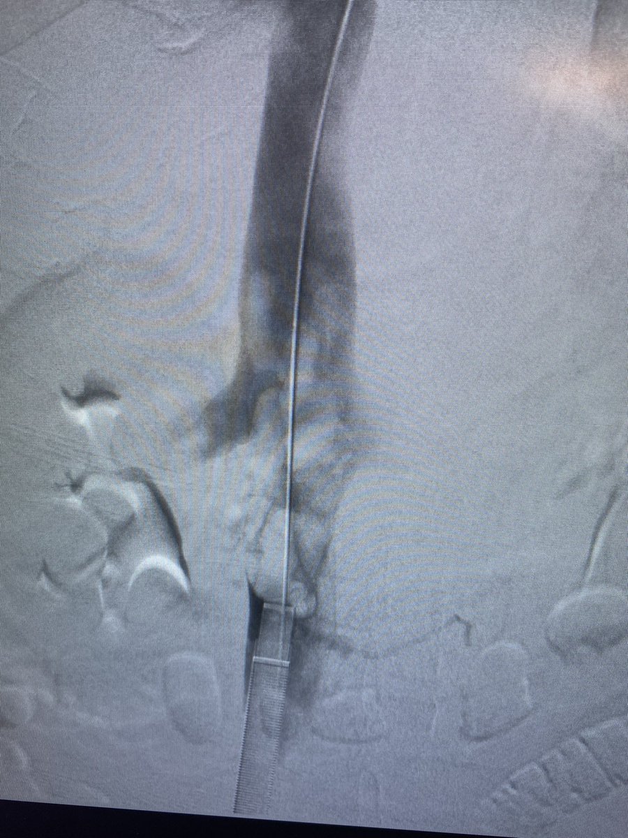 CharlesLugo007's tweet photo. Lollipop clot part 1. @InariMedical @StonyBrookMed @KutsenkoMD @DoctorCliffyy @drvarshana https://t.co/WR02Cz5kyQ