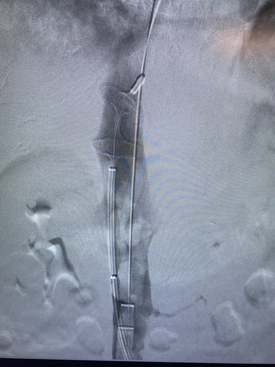 CharlesLugo007's tweet photo. Lollipop clot part 1. @InariMedical @StonyBrookMed @KutsenkoMD @DoctorCliffyy @drvarshana https://t.co/WR02Cz5kyQ