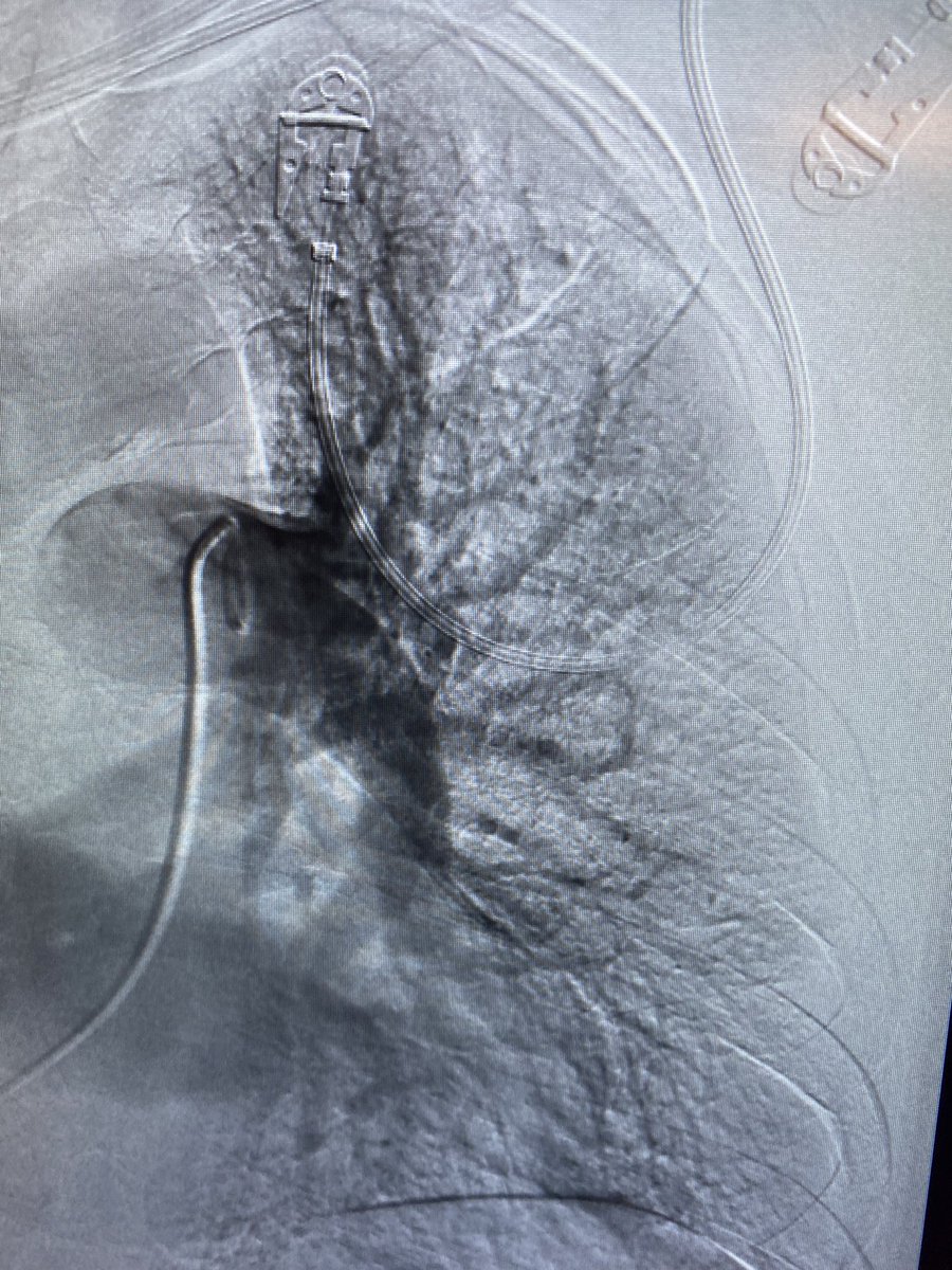 CharlesLugo007's tweet photo. Lollipop clot part 1. @InariMedical @StonyBrookMed @KutsenkoMD @DoctorCliffyy @drvarshana https://t.co/WR02Cz5kyQ