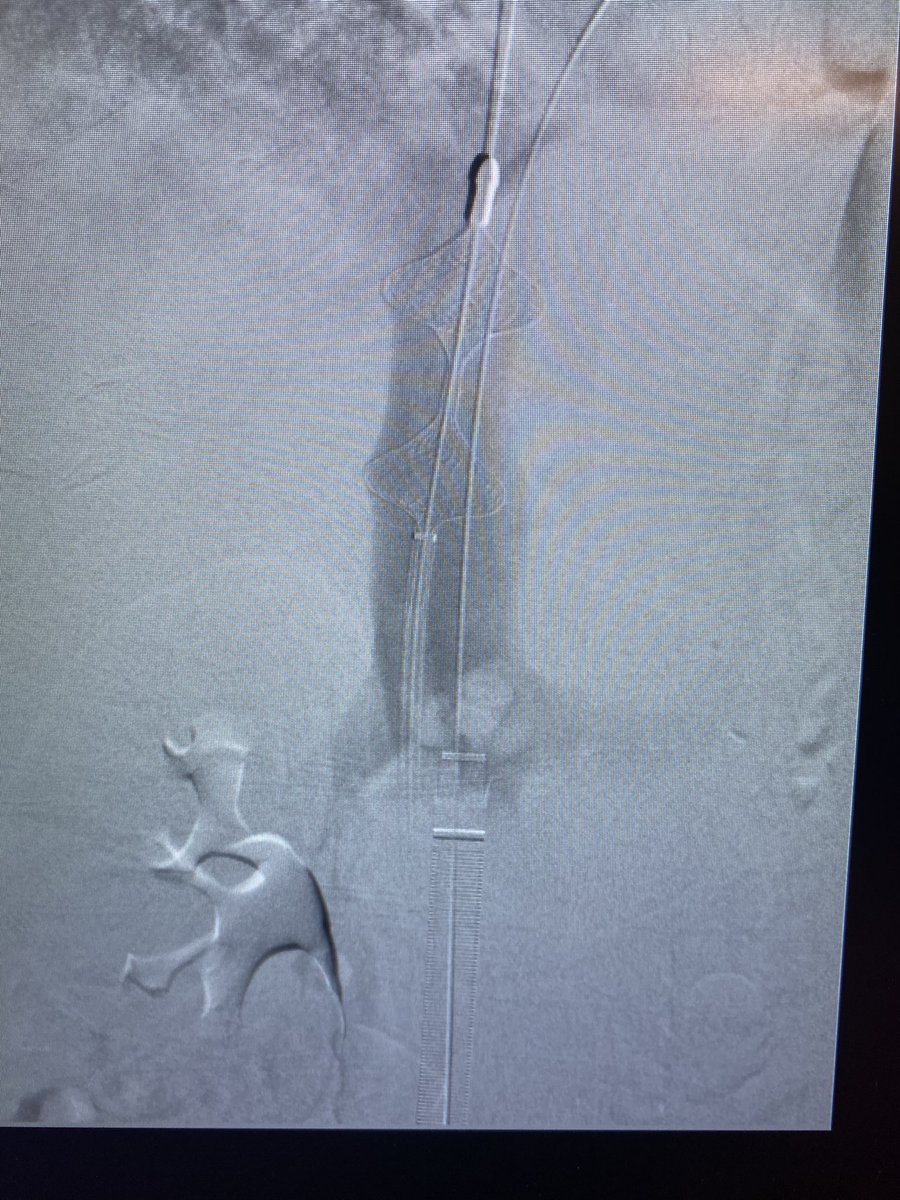 CharlesLugo007's tweet photo. Lollipop clot part 2 (same case). @drvarshana @KutsenkoMD @DoctorCliffyy @InariMedical https://t.co/JLuZ6Cc4Ft