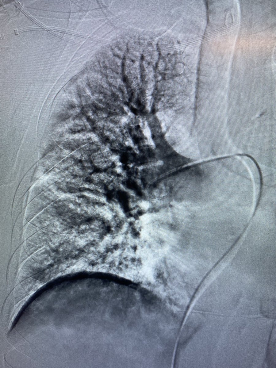 CharlesLugo007's tweet photo. Lollipop clot part 2 (same case). @drvarshana @KutsenkoMD @DoctorCliffyy @InariMedical https://t.co/JLuZ6Cc4Ft
