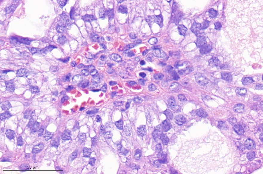 Let's see what we think of this lesion and if we can get consensus. Would you like to order any stains? Had this interesting case with Dr. Brogi <a href="/EdiBrogi/">Edi Brogi</a>. <a href="/rufaida87/">Rufaida</a> <a href="/ADamronMD/">Alexander Damron, MD</a> <a href="/DrGeeONE/">Olaleke Folaranmi</a> <a href="/LizaMQuintana/">Liza Quintana, MD</a> <a href="/DrShiWei/">Shi Wei, MD, PhD</a> <a href="/TheodoreVMD/">Theodore Vougiouklakis, MD</a> <a href="/HansiniMD/">Hansini Laharwani</a> <a href="/mhassanaimc/">Masood Hassan</a> <a href="/CMOmbresMD/">Christina Ombres</a> <a href="/ac_pathgal/">Aastha Chauhan</a>