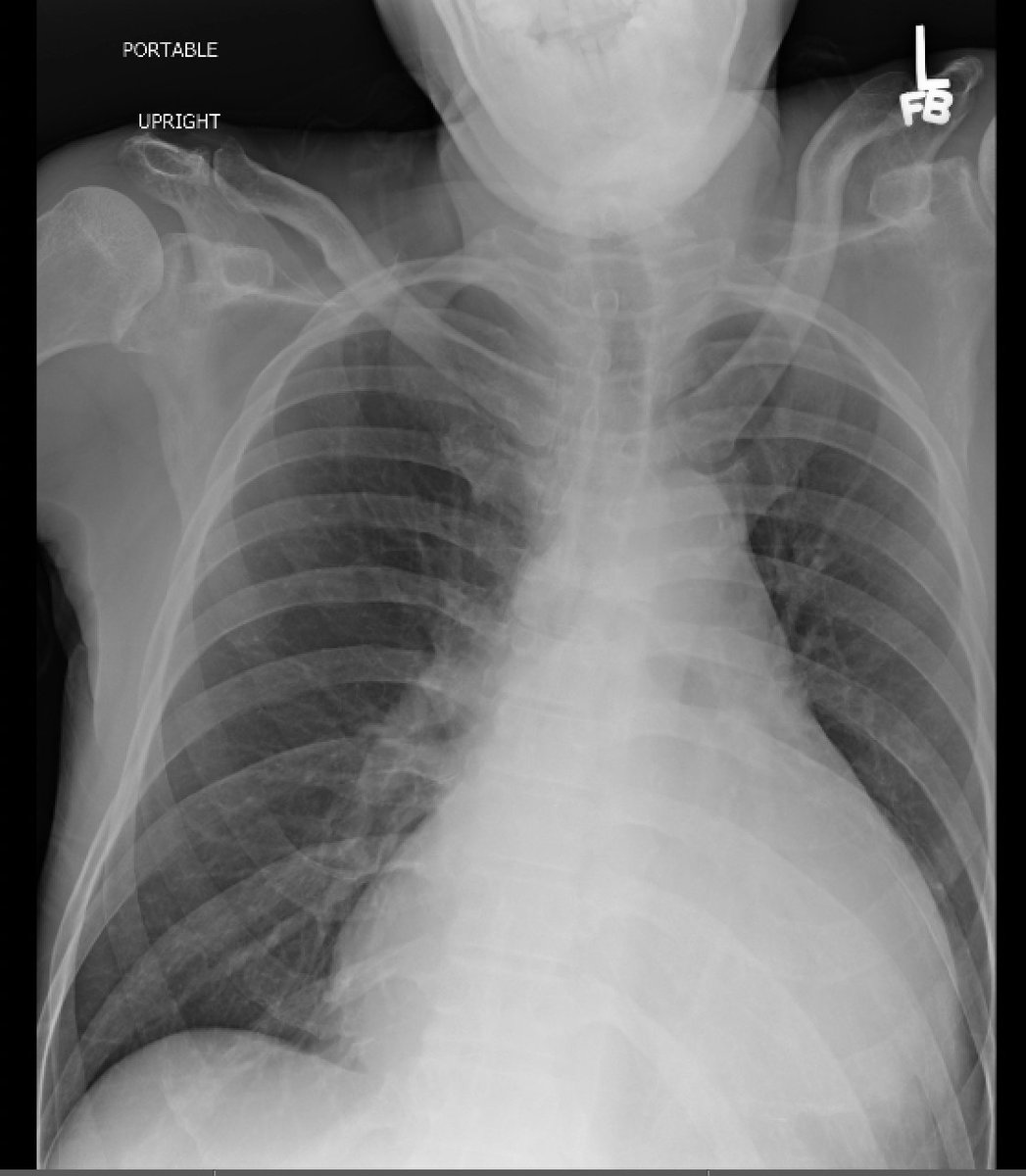Today's CXR for dyspnea...