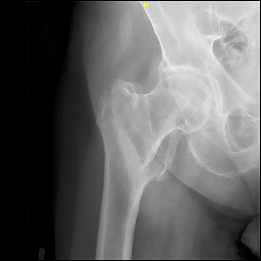 _Anesthesiology's tweet photo. After surgery for hip fracture, patients receiving spinal #anesthesia reported statistically higher yet not clinically meaningful worse pain scores within 24 h and greater analgesic use 60 days post-surgery compared to those receiving general anesthesia. https://t.co/b52kF4U7TL https://t.co/bPUZTO9PLS