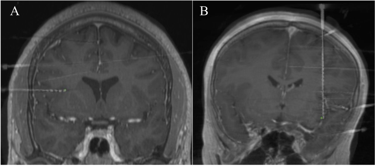 EpilepsiaOpen's tweet photo. Insulo‐opercular stereoelectroencephalography exploration in children and young adults: Indications, Techniques, and Safety https://t.co/fauX7uomw3 

#openaccess #epilepsy #s @IlaeWeb @WileyNeuro @yesILAE @EpilepsiaOpenEEG #operculum #pediatric https://t.co/14MuVsnarS