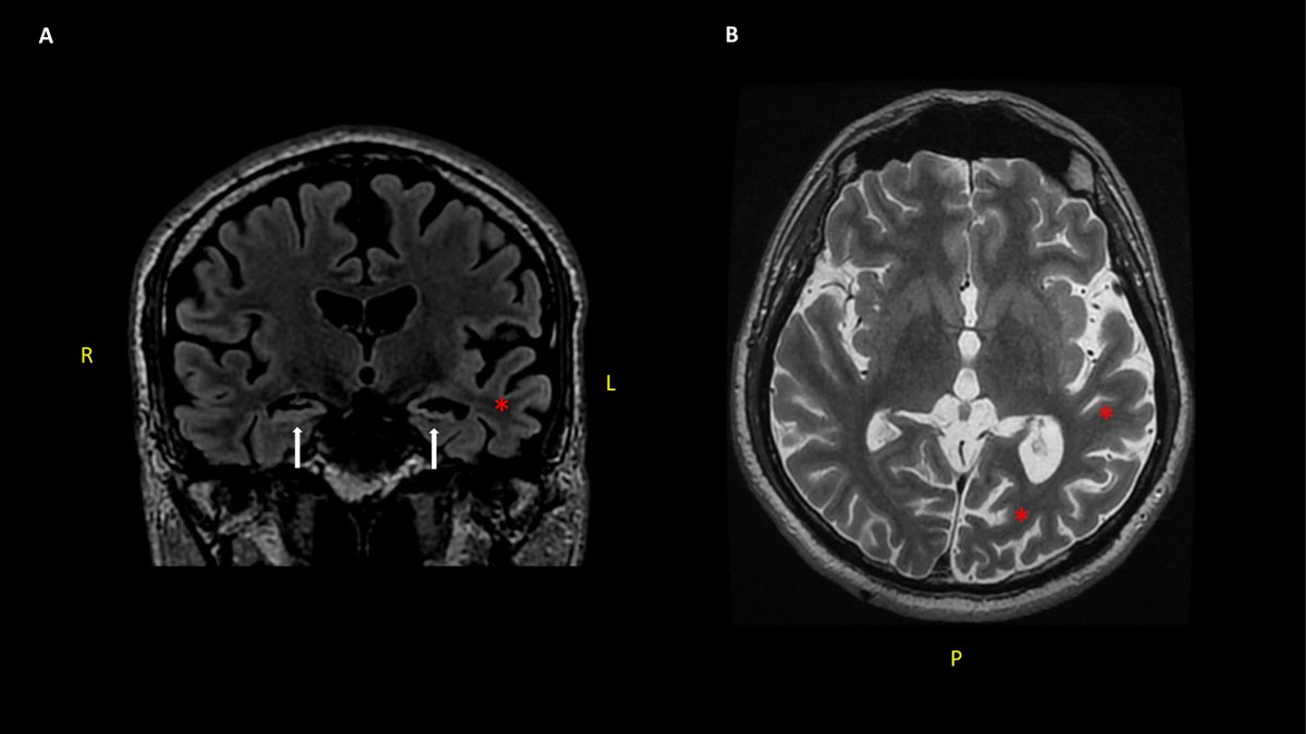 EpilepsiaOpen's tweet photo. Long Term outcomes after NORSE: Treatment with Vagus Nerve Stimulation https://t.co/uE6PzcJEa5 

#openaccess #epilepsy #Statusepilepticus #autoimmune #encephalitis #VNS #NORSE @IlaeWeb @WileyNeuro @yesILAE @EpilepsiaOpen https://t.co/ZnMcsAYMP1