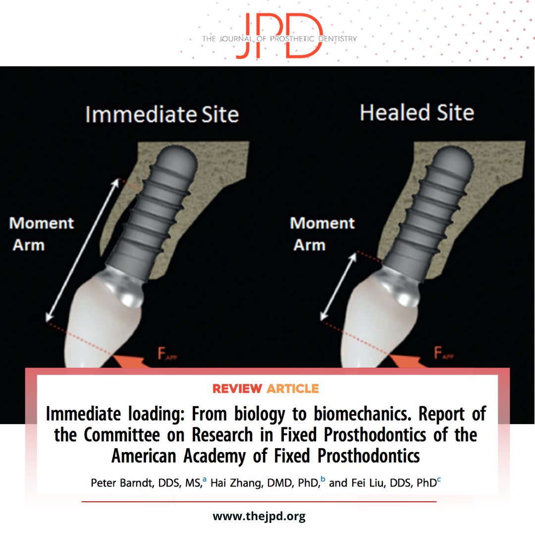 JPDentistry's tweet image. The biologic and mechanical parameters in success versus failure with #immediateloading of different types of clinical #dentalimplant scenarios are summarized in this article from #theJPD. Learn more: thejpd.org/article/S0022-…