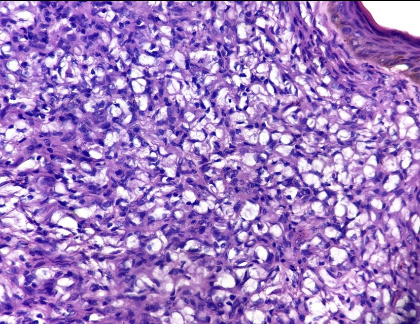 JHoDermPath's tweet photo. It’s been so long!
I don’t get these too often, had to post
-Dense foamy macrophages superficially
-Elongate granulomas following the neurovascular bundles
-Positive Fite stain
Leprosy! (borderline)
#dermpath #PathTwitter #pathologists #derm #dermatology https://t.co/0v7tfGJSe4
