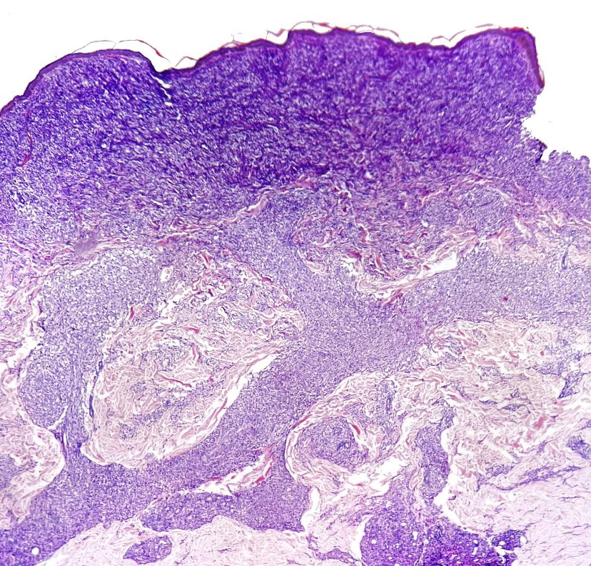JHoDermPath's tweet photo. It’s been so long!
I don’t get these too often, had to post
-Dense foamy macrophages superficially
-Elongate granulomas following the neurovascular bundles
-Positive Fite stain
Leprosy! (borderline)
#dermpath #PathTwitter #pathologists #derm #dermatology https://t.co/0v7tfGJSe4