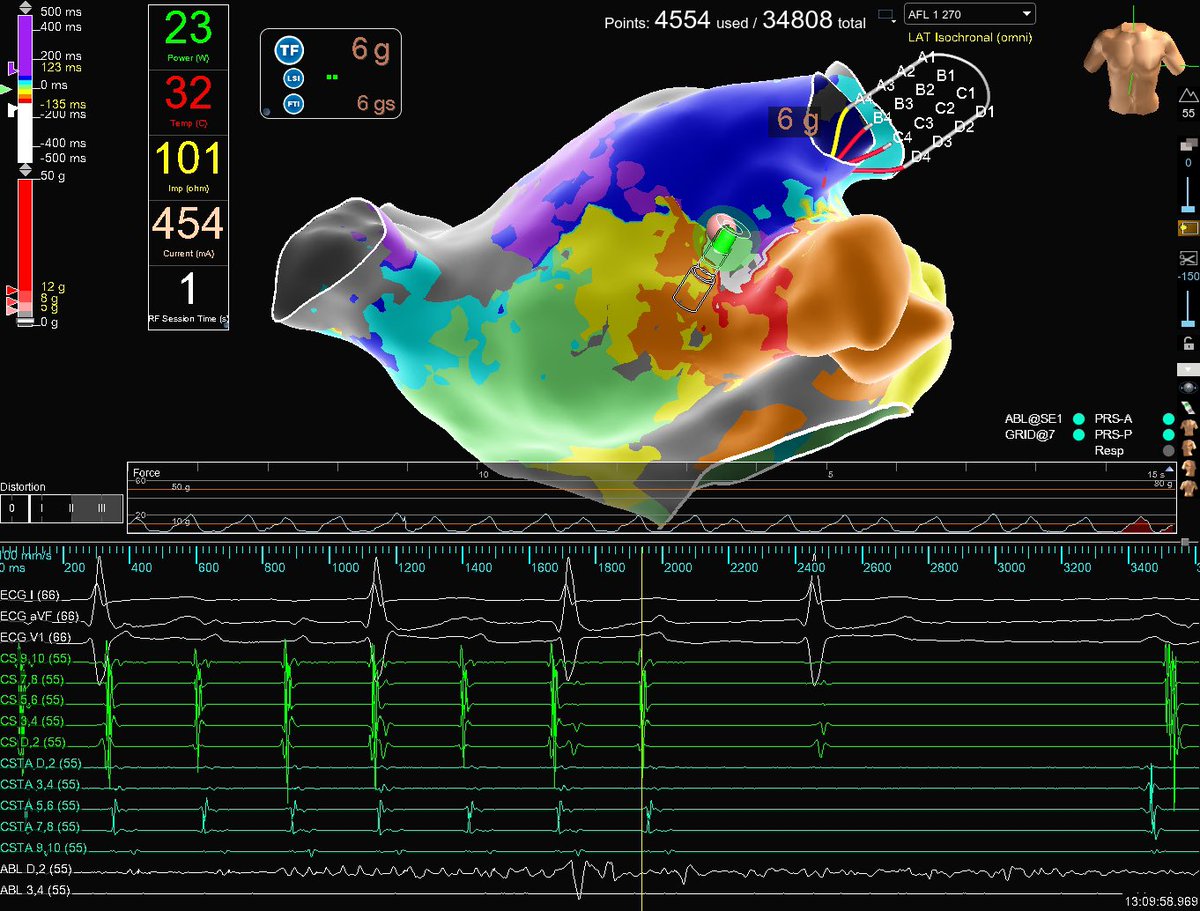 Very elusive LA Atypical AFL utilizing the reconnected LSPV. Circuit mapped on #EnsiteX with #HDGrid &amp; #OT to identify the critical isthmus. Termination of tachycardia achieved within 1 second with a single RFA application. Map Credit: <a href="/BrianOttoEP/">Brian Otto</a> #mapmoreburnless