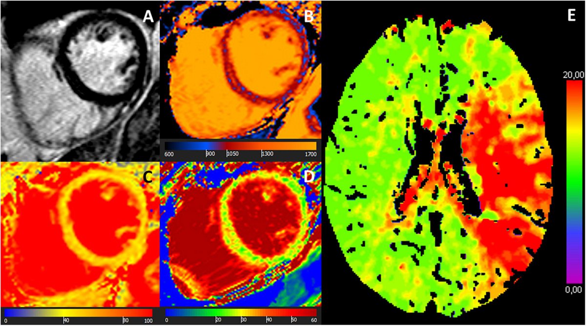 patrickkrumm's tweet photo. #TRoponin of Unknown origin in #STroke evaluated by #whyCMR - The TRUST-MI study: non-ischemic and #ischemic #myocardial lesions suggest substantial rate  not caused by #thrombotic coronary lesions #cardiotwitter #Neurology @Prof_Mahrholdt @uktuebingen https://t.co/CIDpLNhssd https://t.co/3Ma79yqQbQ