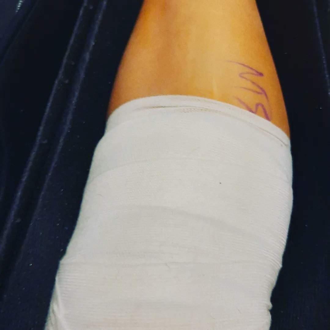 Rusteia's tweet photo. My #meniscalrootrepair aka my #kneearthroscopy aka #kneesurgery journey today! That #generalanesthesia had me passing out left and right on the way home. Even had me stir crazy trying to clean my room!! Grrr. . I will let go of my OCD soon and relax!! #dayone #happyfriday 🦵🏽🍗🦿 https://t.co/8LX1QgcWN4