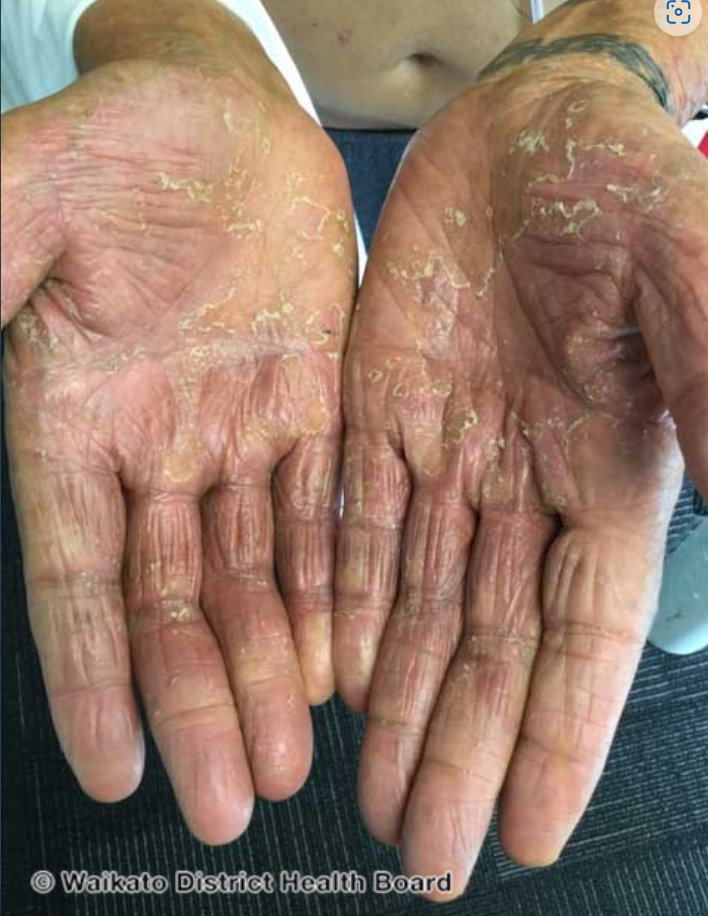 Dr_Aween_LiaNa's tweet photo. DOKTOR, GATALNYAAA TANGAN SAYA!!

Hello orang ramai!

Siapa pernah jadi tangan mcm ni? Bila kena air ke, basuh seafood ke, berus baju ke..gatal nye, sakit nye…aduh Allah je tahu. If you have it, then you are not ALONE. I have it too sobs.

Ok threads! https://t.co/QDLc5E1c7c
