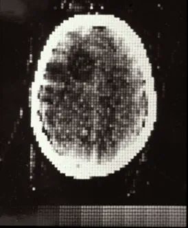 The first CT image of a human patient was acquired on this day October 1 at Atkinson Morley Hospital in London, with a scanner designed by Sir Godfrey Hounsfield. #OTD #radiology @StGeorgesTrust #radiology #medicalimaging bit.ly/3zMRYl7