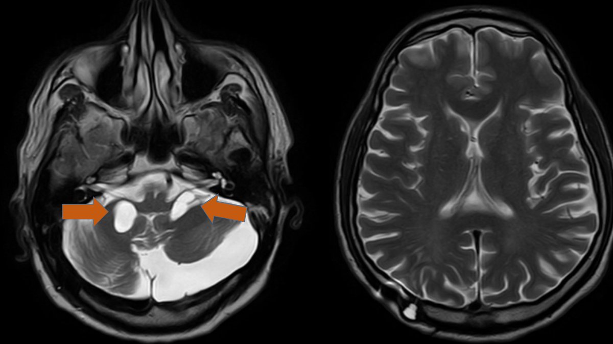 Clinical pearl; Rarely do you get to see trapped Foraminae of Lushka. These antero-lateral outlets of the IVth ventricle are trapped and dilated (orange arrows) in this patient with Neurosarcoidosis, s/p VP shunting