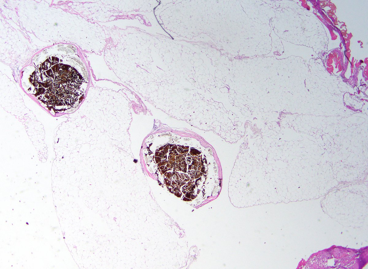BWHPath's tweet photo. #BWHPathCotW

Omental nodule resected during surgical staging from a woman with endometrial adenocarcinoma. Can you name the finding?

#GYNpath 1/ https://t.co/SFgqjHpyCx