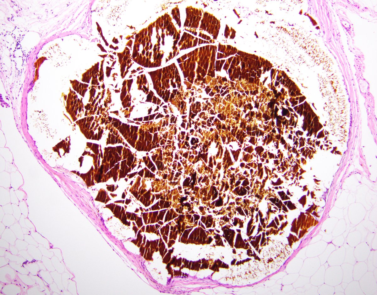 BWHPath's tweet photo. #BWHPathCotW

Omental nodule resected during surgical staging from a woman with endometrial adenocarcinoma. Can you name the finding?

#GYNpath 1/ https://t.co/SFgqjHpyCx