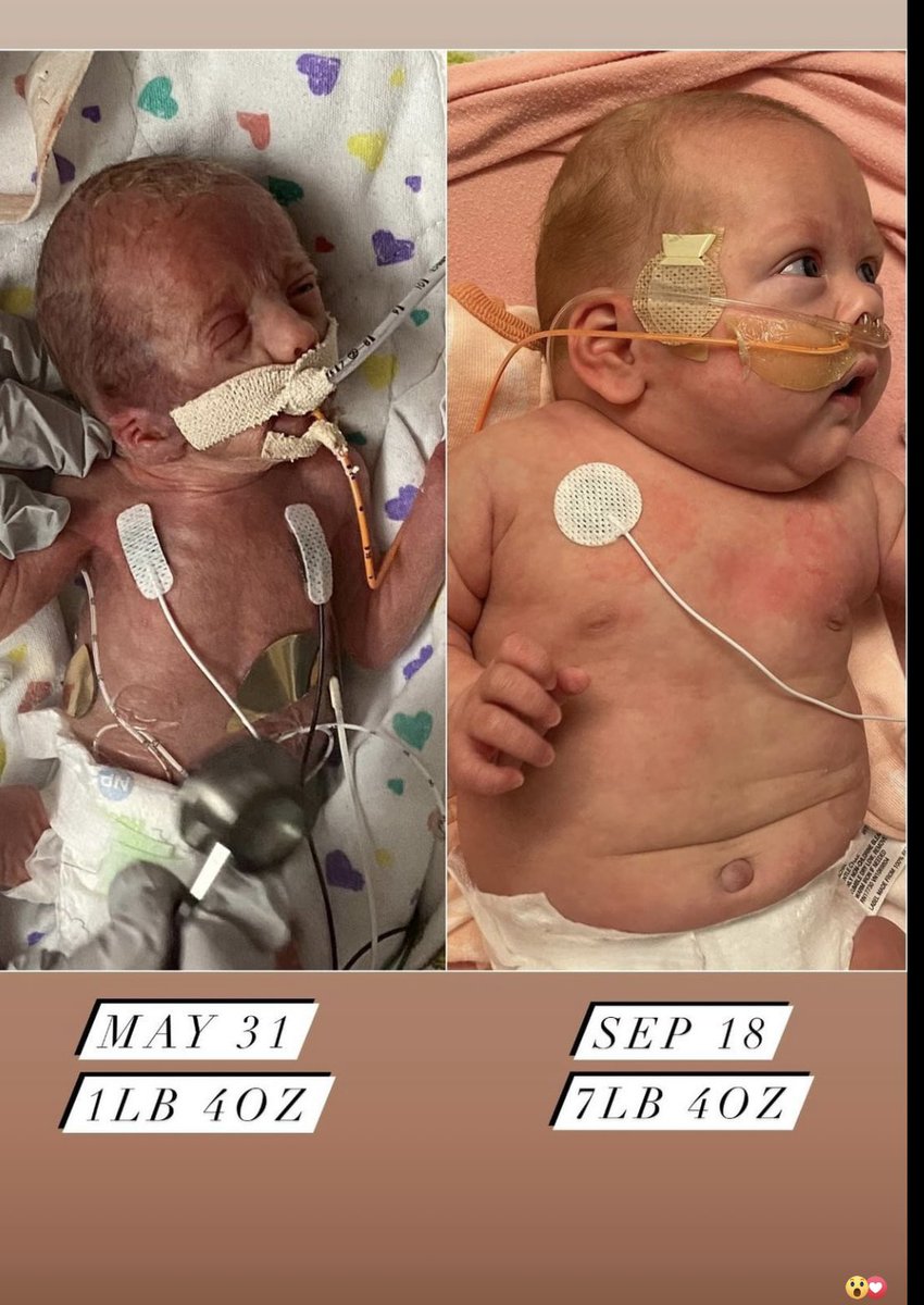 Our precious miracle, modern medicine is incredible as well as the Dr's and nurses! We're hoping Josephine gets to go home soon. gofund.me/74f97411