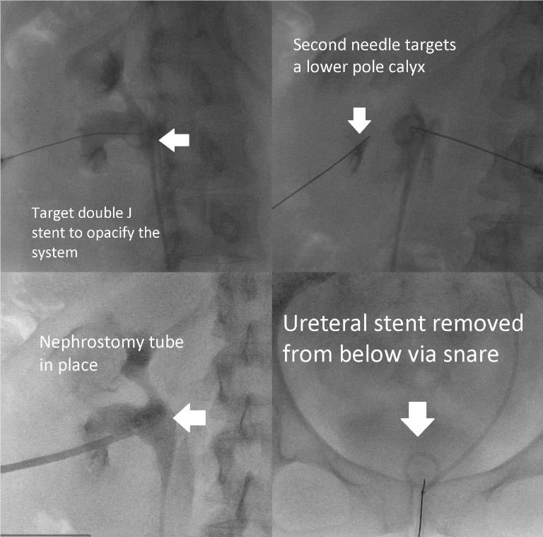 Non-dilated collecting system where ureteral stent failed to control a post-operative leak. Interventional radiology (#IRad) placed a nephrostomy tube for diversion using fluoroscopic landmarks. Then, #radres <a href="/CathyChen4/">Cathy Chen | 陳曦</a> expertly removed the stent with a snare from below.