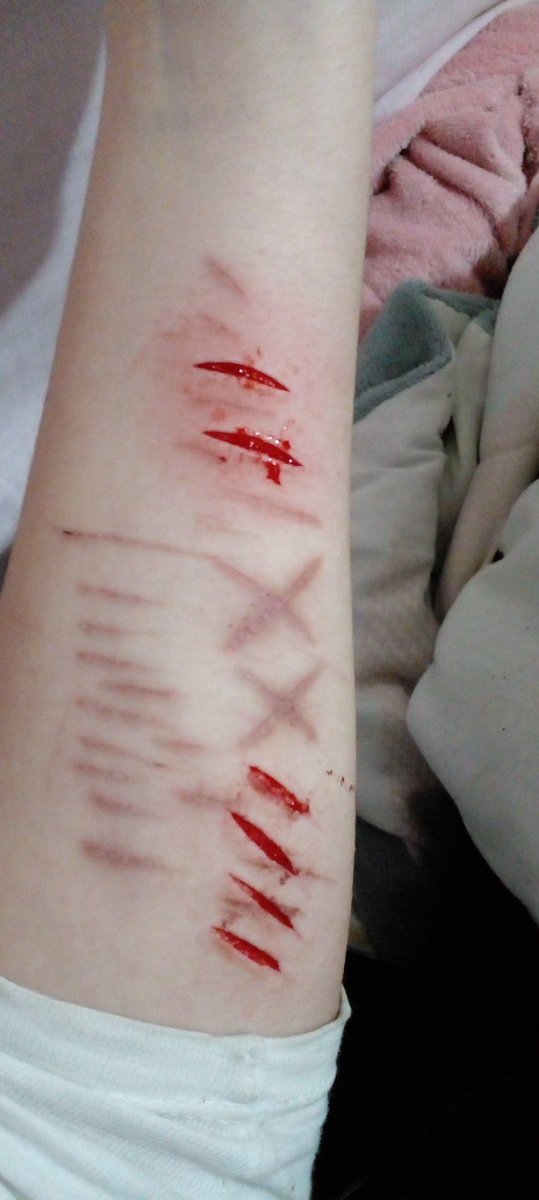 innegore's tweet photo. tw//sh
.
.
.
.
.
.
.
antes e depois, queria mt que as cicatrizes sumissem logo https://t.co/8fPenKwKYo