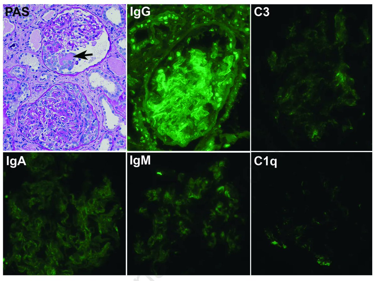 KidneyMed's tweet photo. Systemic Lupus Erythematosus and ANCA-Associated Vasculitis Overlap Syndrome: A Case Report 

https://t.co/FGNKCTO9gG https://t.co/6sN37OdPTb