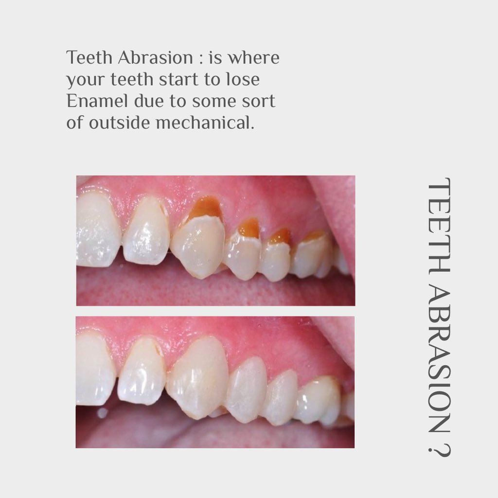 • تآكل مينا الأسنان !
⁃ مينا الأسنان عبارة عن السطح الخارجي الصلب من الأسنان، هذه الطبقة هي الأكثر صلابة في جسم الإنسان، ولكنها قد تتآكل تدريجيًا مع مرور الوقت.
• أسباب فقدان مينا الأسنان ؟ 
⁃ تفريش الأسنان بقوة شديدة.
⁃ تآكل الأسنان بسبب الأحماض.