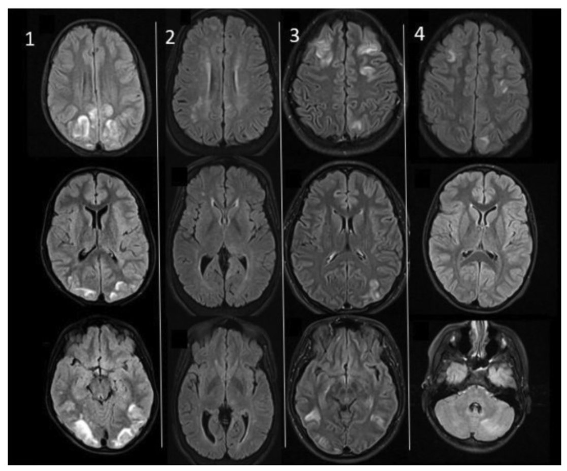 How does PRES look on MRIs in infants and children as compared to adults? -less posterior lesions; 9/19 with frontal -f/u MRIs: edema resolves, but new atrophy Read full article from our Oct issue ⬇️: bit.ly/3RWA1bo @The_ASPNR @RSNA