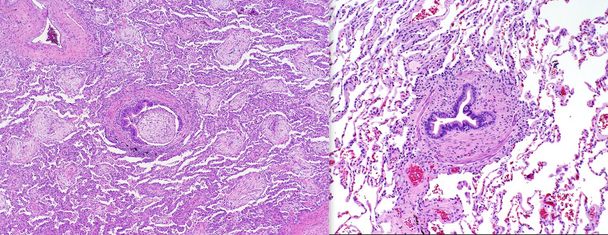 John Carney (@jmcarneymd) on Twitter photo Lung injury patterns which often get confused with each other. Can you name these patterns? Differential? <a href="/KMirza/">Kamran Mirza MD PhD - کامران مرزا</a> <a href="/Sara_Jiang/">Xiaoyin "Sara" Jiang, MD (She/Her)</a> Lung injury patterns which often get confused with each other. Can you name these patterns? Differential? <a href="/KMirza/">Kamran Mirza MD PhD - کامران مرزا</a> <a href="/Sara_Jiang/">Xiaoyin "Sara" Jiang, MD (She/Her)</a>